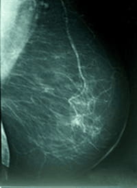 Descubren un nuevo enfoque para prevenir la progresión del cáncer de mama