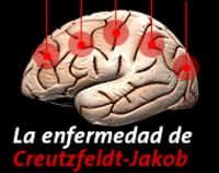 Enfermedad de Creutzfeldt-Jakob