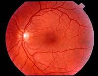 Los medicamentos para reducir el colesterol pueden ser eficaces para la degeneración macular