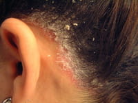 Descubren una enzima relacionada con la psoriasis
