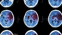 El cambio de hora puede prevenir enfermedades neurodegenerativas