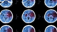 Relacionan virus del herpes y alzhéimer