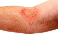 Psoriasis y obesidad se dan la mano en los niños