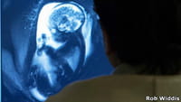 Un compuesto experimental revierte déficits de aprendizaje en síndrome de Down