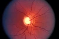 Glaucoma, el