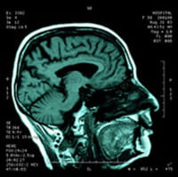 Cómo la adicción a la heroína podría cambiar la función cerebral