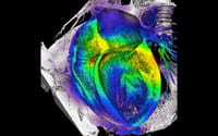 Descubren dos mutaciones asociadas a una miocardiopatía grave